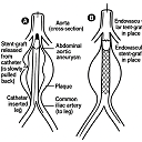BIMA Bypass Surgery